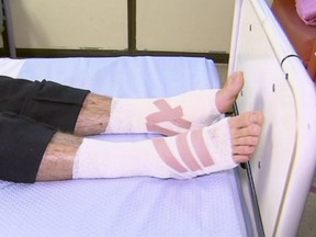 In this image made from video, the legs of Sam Kanizay, 16, are seen on a bed of a hospital where he is treated, in Melbourne, Australia, Monday, Aug. 7, 2017.