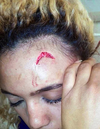 Model Gabriella Engels shows an injury to her forehead.