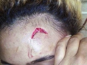 In this photo provided by Debbie Engels and taken on Monday, Aug. 14, 2017, Gabriella Engels is seen with an injury to her forehead in Johannesburg, South Africa. Twenty-year-old model Gabriella Engels has accused Grace Mugabe of assaulting her on Sunday, Aug. 13 while she was visiting Mugabe's sons in a hotel room in an upscale Johannesburg suburb. She claims the first lady's bodyguards stood by and watched as Mugabe attacked her. (Debbie Engels via AP)