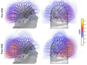 This image provided by the CNRS Marc Jeannerod Institute of Cognitive Science in Lyon, France, shows brain activity in a patient before, top row, and after vagus nerve stimulation. Warmer colors indicate an increase of connectivity. In a report published Monday, Sept. 25, 2017, French doctors say they restored some signs of consciousness in a brain-injured man who hadn't shown any awareness in 15 years.