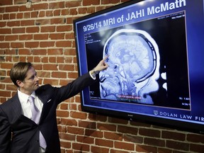 In this Friday, Oct. 3, 2014, file photo, Attorney Christopher Dolan points to a recent MRI of Jahi McMath during a news conference at his law office in San Francisco. A California judge ruled that a teen girl declared brain dead more than three years ago after a tonsillectomy may still be technically alive, allowing a malpractice lawsuit against the hospital to proceed, Tuesday, Sept. 5, 2017. (AP Photo/Eric Risberg, File)
