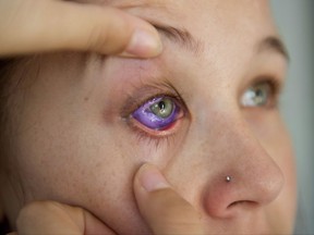 Catt Gallinger, who had a botched ink injection in her eyeball, shows the amount of swelling in her eye, at home in Ottawa on Friday, Sept. 29, 2017