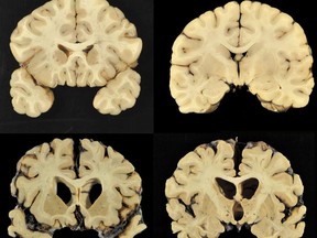 This combination of photos provided by Boston University shows sections from a normal brain, top, and from the brain of former University of Texas football player Greg Ploetz, bottom, in stage IV of chronic traumatic encephalopathy. According to a report released on Tuesday, July 25, 2017 by the Journal of the American Medical Association, research on 202 former football players found evidence of a brain disease linked to repeated head blows in nearly all of them, from athletes in the National Football League, college and even high school. (Dr. Ann McKee/BU via AP)