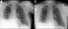 Chest X-rays two weeks before and then four months after the toy was removed.