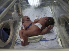 A pair of conjoined twin sisters, born Saturday, lie in an incubator at Shifa hospital, in Gaza City, Monday, Oct. 23, 2017. Dr. Allam Abu Hamda, a neonatal specialist at Gaza's Shifa hospital, said Monday that the girls are in "stable" condition and doctors have begun feeding them, but they will need treatment abroad. (AP Photo/Adel Hana)