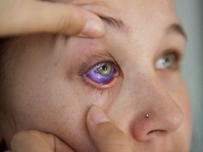 Catt Gallinger, who had a botched ink injection in her eyeball, shows the amount of swelling in her eye, at home in Ottawa on Friday, Sept. 29, 2017. The Ontario government says it will ban the practices of eyeball tattooing and implanting eye jewellery after health professionals urged action to prevent the dangerous trends.THE CANADIAN PRESS/Justin Tang
