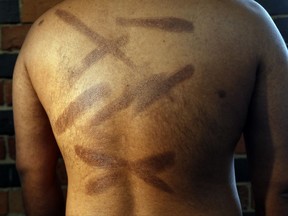 FILE - In this July 18, 2017, file photo, a Sri Lankan man known as Witness #199 shows the scars on his back during an interview in London. He is one of more than 50 ethnic Tamil men seeking political asylum in Europe, after they were, they said, abducted and tortured under Sri Lanka's current regime. Sri Lanka's defense minister denied Tuesday, Nov. 14, that his country committed torture and rape of suspected rebels, as charged by more than 50 Tamil ethnic minority men. (AP Photo/Frank Augstein, File)