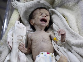 A Syrian infant suffering from severe malnutrition is seen at a clinic in the rebel-controlled town of Hamouria, in the eastern Ghouta region on the outskirts of the capital Damascus, on October 21, 2017.