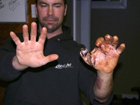 This 2010 photo provided by Trent Procter shows Procter, of Swan River, Manitoba, during rehabilitation, months after his Savage Arms stainless steel 10ML-II muzzleloader exploded and severely injured his left hand. Savage Arms recently agreed to pay a confidential settlement to Procter to resolve his lawsuit, one of several that allege the company kept a defective firearm on the market.