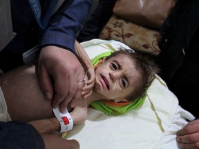 This photo provided on Monday, October 30, 2017 by UN Office for the Coordination of Humanitarian Affairs (OCHA), shows a severely malnourished child at the al-Kahef hospital in Kafr Batna, Eastern Ghouta near Damascus, Syria. Humanitarian officials are warning that conditions outside Syria's capital have reached crisis levels, as the government refuses to give up a siege against its opponents that has trapped close to 400,000 people without enough food, fuel or medicine for the winter. (UN OCHA via AP)