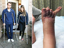Windsor residents Eddie Zytner and his girlfriend Katie Stephens need crutches after both contracted the parasitic condition called cutaneous larva migrans - hookworms - on a vacation in the Dominican Republic in January 2018.