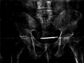 An X-ray image of army vet Glenford Turner's midsection showed, to quote the lawsuit, “an abandoned surgical instrument in plaintiff’s body.”