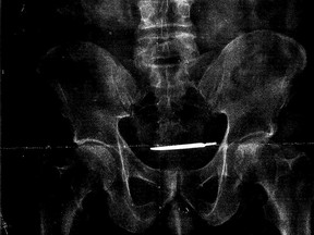 This X-ray image provided by the attorney for Glenford Turner, of Bridgeport, Ct., shows a scalpel that Turner claims was left inside him after undergoing surgery in 2013 at a Veterans Administration hospital in Connecticut. The army veteran is suing the hospital after the scalpel was only discovered years later and he suffered from long-term abdominal pain. (Courtesy of FAXON Law Group via AP)