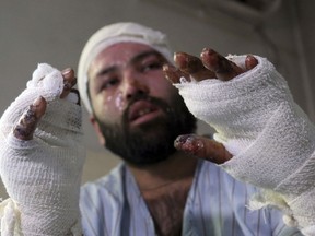 In this Wednesday, Jan. 10, 2018 photo, photographer Sayed Mushtaq Hossaini, 26, who was injured in a suicide attack, holds up his hands at a hospital in Kabul, Afghanistan. For Hossaini, some of the horrors of the day last month when an Islamic State suicide bomber struck a weekly meeting at a Shiite cultural center in Kabul remain a blur. He remembers hiding behind a pillar in the room, terrified for his life, watching as the flames engulfed his hands and face.