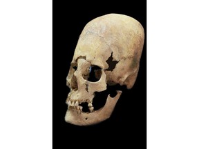 Photo provided by the State collection for Anthropology and Palaeoanatomy Munich shows an artificially deformed female skull from Altenerding, an Earyl Medieavel site in Bavaria., Germany. Scientists investigating unusual skulls found at dozens of 5th and 6th century burial sites say they appear to provide evidence of long-distance female migration at a time when the continent was being reshaped by the collapse of the Roman empire. (State collection for Anthropology and Palaeoanatomy Munich via AP)