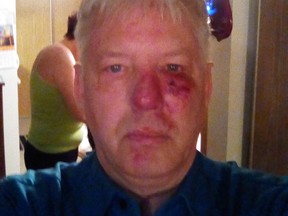 Tim Dyck – the 52-year-old gospel singer attacked outside a Prince Albert concert – with bruises on his face after the incident.