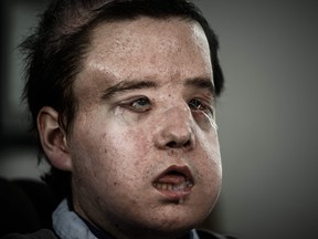 Jerome Hamon, the first man in the world to twice undergo a face transplant after flu tablets incompatible with his anti-rejection treatment led to the first attempt to fail, poses on April 13, 2018.