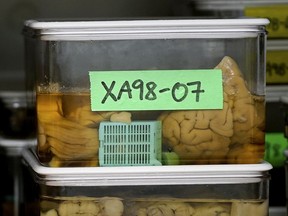 This Feb. 16, 2018, photo shows slices of human brains researchers at Northwestern University are using to study Alzheimer's disease in Chicago. Scientists are proposing a new way to define Alzheimer's disease, basing it on biological signs such as brain changes, rather than memory loss and other symptoms of dementia that are used now.