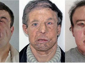 In this undated combination handout photo provided on Tuesday, April 17, 2018 by HEGP AP-HP,  Jerome Hamon before and after two transplants. In a medical first, a French surgeon says he has performed a second face transplant on the same patient _ who is now doing well and even spent a recent weekend in Brittany. Dr. Laurent Lantieri of the Georges Pompidou hospital in Paris first transplanted a new face onto Jerome Hamon in 2010. But after getting ill in 2015, Hamon was given drugs that interfered with anti-rejection medicines he was taking for his face transplant. (HEGP AP-HP via AP)