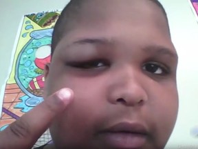 In this image taken from a June 2014 video by 12-year-old Ralph White via the Disability Rights Project, White points to the black eye given to him by a caretaker at the Northeast Parent and Child Society home in Schenectady, N.Y. White, who was developmentally disabled, also used his gaming console to record his caretakers threatening his life. White's family received a $450,000 settlement from the facilities's private operators.