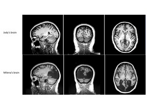 In comparison to the brain of a person of similar age, the back portion of Milena Canning’s brain was damaged by strokes.