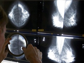 A radiologist uses a magnifying glass to check mammograms for breast cancer in Los Angeles, May 6, 2010.