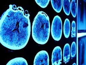 Brain tumors called glioblastomas often recur after initial treatment and survival is usually less than a year.