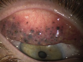 A 50-year-old woman damaged her eyes by not properly removing her mascara for 25 years.