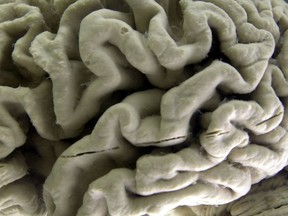 FILE - This Oct. 7, 2003 file photo shows a section of a human brain with Alzheimer's disease on display at the Museum of Neuroanatomy at the University at Buffalo, in Buffalo, N.Y. On Wednesday, July 25, 2018, two drug makers said an experimental therapy slowed mental decline by 30 percent in patients who got the highest dose in a mid-stage study, and it removed much of the sticky plaque gumming up their brains. The drug, called BAN2401, is from Eisai and Biogen.