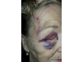 This February 2018 photo released by Ashlee Hahn shows injuries to Hahn's grandmother Virginia Archer. Archer alleges she was seriously injured by officers of an Arizona police department already under fire for numerous complaints of excessive force has filed a federal civil lawsuit against two policemen and their department.