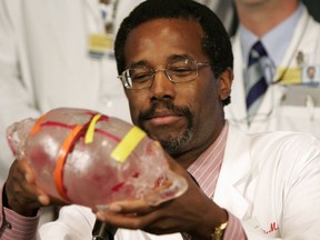 FILE - In this Sept. 16, 2004, file photo, Dr. Ben Carson, then-director of pediatric neurosurgery at Johns Hopkins Children's Center, holds a model of the heads of conjoined twins Tabea and Lea Block of Lemgo, Germany, during a news conference in Baltimore. Carson's story of growing up in a single-parent household and climbing out of poverty to become a world-renowned surgeon was once ubiquitous in Baltimore, where Carson made his name. But his role as Housing and Urban Development Secretary in the Trump Administration has added a complicated epilogue, leaving many who admired him feeling betrayed, unable to separate him from the politics of a president widely rejected by African Americans here.