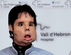 “Oscar” in July 2010, after he received the worldâs first full facial transplant.