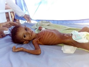 This undated 2018 handout image provided by Dr. Mekkiya Mahdi, Head of Aslam Health Center, shows a severely malnourished child at the Aslam Health Center in Hajjah, Yemen. Before the war, the health center would see one or two malnourished children a month. This year, it has seen around 700. In August 2018 alone, it received 99 cases, nearly half of them in the most severe stages, the center's nutrition chief Khaled Hassan said.