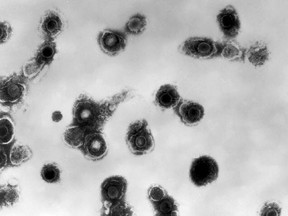 This 1981 electron microscope image made available by the Centers for Disease Control and Prevention shows varicella-zoster virions from a patient with chickenpox. On Thursday, Oct. 11, 2018, the CDC says a small but growing proportion of U.S. toddlers have not been vaccinated against any disease.