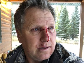 This photo provided by Bob Legasa shows him after a bear attack near Livingston, Mont., Saturday, Oct. 13, 2018. Legasa, who is having a second surgery for his injuries Monday, Oct. 15,2018, says he expects to be discharged Tuesday, three days after he was mauled by a grizzly sow protecting her cub. (Bob Legasa via AP)