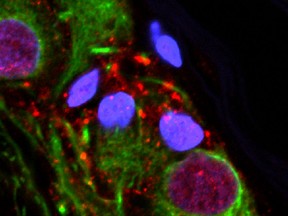 This microscope image provided by the Van Andel Research Institute in October 2018 shows an abnormal protein that is a hallmark of Parkinson’s disease clumped inside the appendix. New research suggests Parkinson’s, a brain disease, may get its start in the gut _ specifically, the appendix.