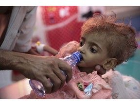 FILE - In this Thursday, Sept. 27, 2018, file photo, a father gives water to his malnourished daughter at a feeding center in a hospital in Hodeida, Yemen. An international aid group says an estimated 85,000 children under age 5 may have died of hunger and disease since the outbreak of Yemen's civil war in 2015.