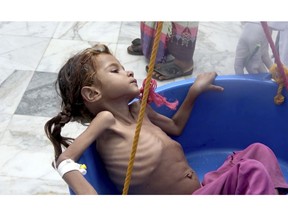 FILE - In this Aug. 25, 2018 file image made from video, a severely malnourished seven-year-old Amal Hussein -- whose name means "hope" in Arabic, is weighed at the Aslam Health Center in Hajjah, Yemen. On Sunday, Nov. 4, 2018, Geert Cappelaere called the situation a "living hell" for all Yemeni children, noting the death of Amal a child whose emaciated body gained attention on the front page of the New York Times last week. In a speech delivered in Amman Cappelaere said, "There is not one Amal -- there are many thousands of Amals."