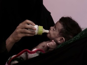 FILE - In this Feb. 13, 2018 file photo, Ahmed Rashid Mokbel, a severely malnourished 7-month-old Yemeni boy, is given formula by his mother at the Al-Sadaqa Hospital in Aden, Yemen. Oxfam, an international aid group, said Wednesday, Dec. 19, 2018, that more than half a million displaced people in war-torn Yemen face the "double threat" of famine and freezing temperatures as winter sets in. Oxfam said that some 530,000 displaced people are in mountainous areas, many living in makeshift shelters with no insulation or weatherproofing.