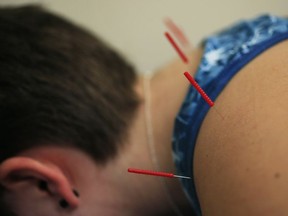Acupuncture needles are applied on Sarah Taylor's back during an acupuncture treatment at the Children's National Medical Center in Washington, Monday, Dec. 10, 2018.  Over and over, the 17-year-old struggled to make doctors understand her sometimes debilitating levels of pain, first from joint-damaging childhood arthritis and then from fibromyalgia.  "It's very frustrating to be in pain and you have to wait like six weeks, two months, to see if the drug's working," said Sarah, who uses a combination of medications, acupuncture and lots of exercise to counter her pain. Children's National Medical Center is testing an experimental device that aims to measure pain according to how pupils react to certain stimuli.