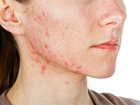 Turns out acne could be good for your grades.