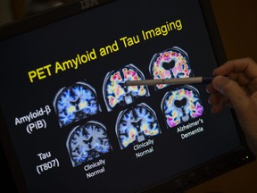 In a May 19, 2015 file photo, R. Scott Turner, professor of neurology and director of the Memory Disorder Center at Georgetown University Hospital, points to PET scan results that are part of a study on Alzheimer's disease at Georgetown University Hospital, in Washington.