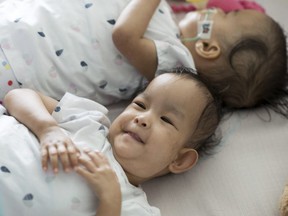 The conjoined twins from Bhutan were separated at an Australian hospital on Nov. 9, 2018 in a delicate operation that divided their shared liver and reconstructed their abdomens.