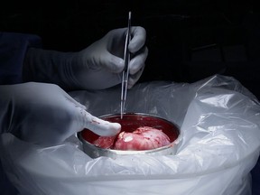 This image made from video provided by Johns Hopkins Medicine in Baltimore shows a kidney from Nina Martinez of Atlanta, who is thought to be the world's first kidney transplant living donor with HIV, on Monday, March 25, 2019. Doctors transplanted one of her kidneys into an HIV-positive recipient who chose to remain anonymous. (Johns Hopkins Medicine via AP)