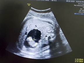 An ultrasound reveals a tiny fetus forming in the abdomen of her twin sister while in the womb, connected by a second umbilical cord and still growing.