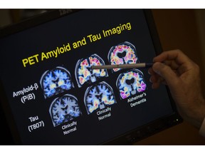 FILE - In this May 19, 2015, file photo, a doctor points to PET scan results that are part of a study on Alzheimer's disease at a hospital in Washington. Scientists know that long before the memory problems of Alzheimer's become obvious, people experience more subtle changes in their thinking and judgment.