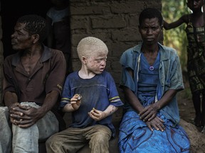 An albino child sits between his parents in the traditional authority area of Nkole, Machinga district, on April 17, 2015. At least 25 albinos have been killed in Malawi since 2014.
