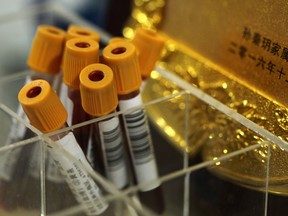 Patients' blood sits in vials at Ruijin Hospital's center for functional neurosurgery in Shanghai, China on Monday, Oct. 29, 2018. Western attempts to push forward with human trials of deep brain stimulation, or DBS, for drug addiction have foundered, even as China emerges as a hub for this kind of research. But rising opioid-related deaths may be changing that. The first U.S. trial of DBS for opioid addiction could begin in West Virginia as early as June.
