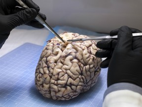 The surgeons removed the mass from Palma's brain and placed it under a microscope to get a closer look. Then they sliced into it — and found a baby tapeworm.