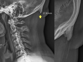 Researchers at the University of the Sunshine Coast in Queensland, Australia, have documented the prevalence of bone spurs at the back of the skull among young adults.